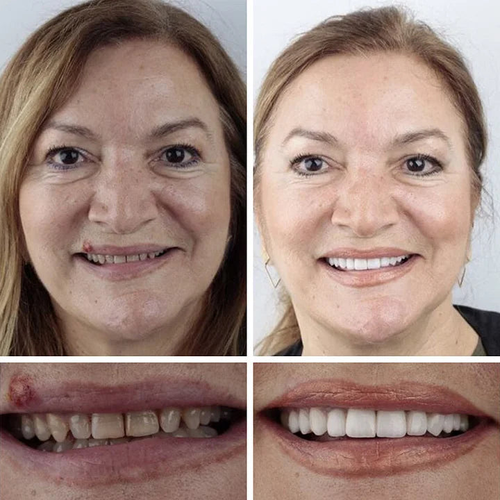 Limited-time sale is about to end! ⏰Pryxo™ Medical Full Denture with Strong Suctiond🦷Obtain American Dental Association (ADA) Certification