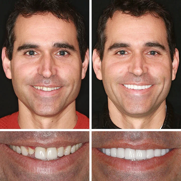 Limited-time sale is about to end! ⏰Pryxo™ Medical Full Denture with Strong Suctiond🦷Obtain American Dental Association (ADA) Certification