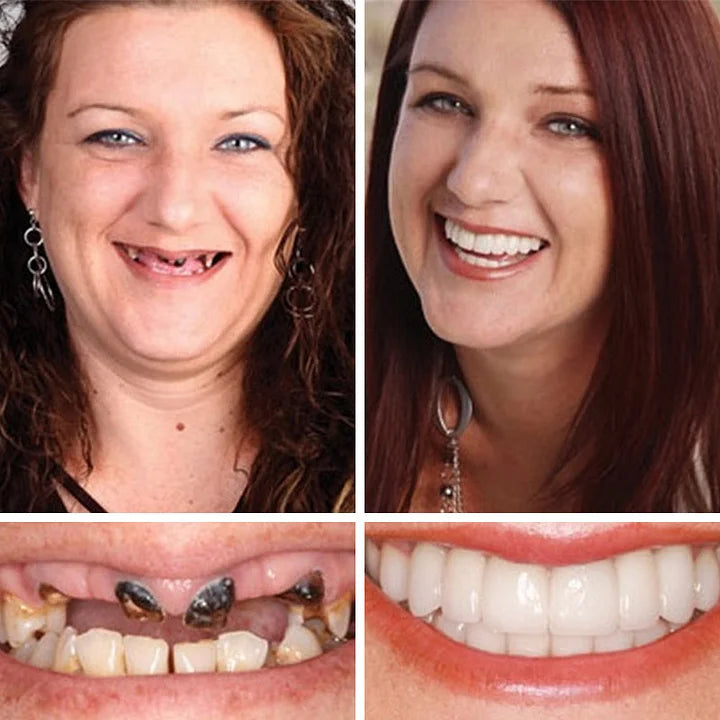 Limited-time sale is about to end! ⏰Pryxo™ Medical Full Denture with Strong Suctiond🦷Obtain American Dental Association (ADA) Certification