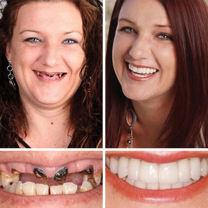 Limited-time sale is about to end! ⏰Pryxo™ Medical Full Denture with Strong Suctiond🦷Obtain American Dental Association (ADA) Certification